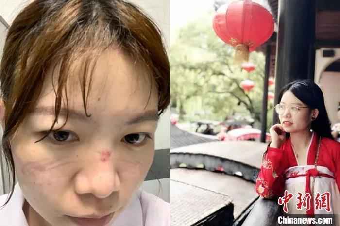 资料图:在湖北“抗疫”一线奋战的护士李万荣脸上被压出伤痕。吴兰 摄  天使,节日快乐!